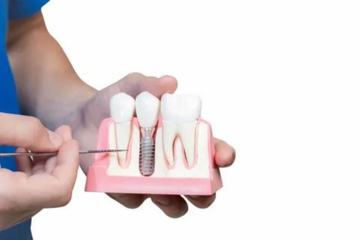 Dental Services- Dental Implants
