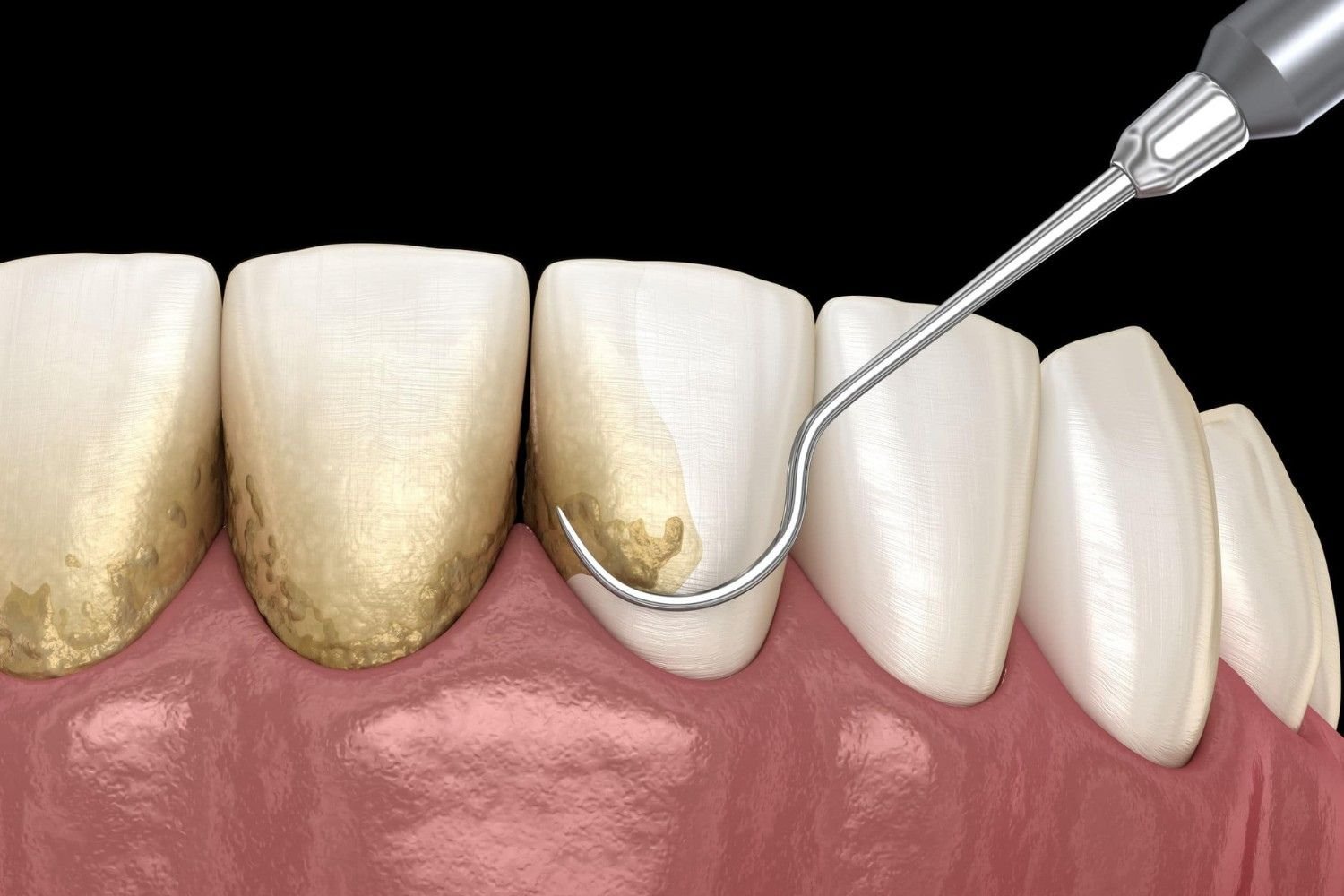 Dental Services- Scaling and Root Planing