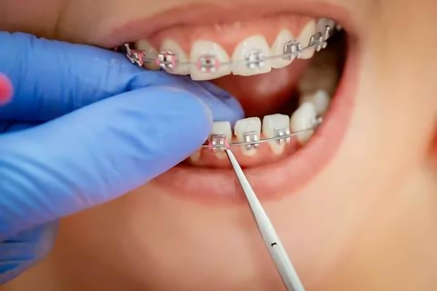 Dental Services- Orthodontic Treatment (Braces / Clear Aligners)