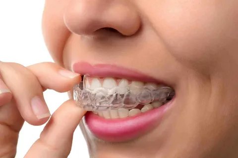 Dental Services- Orthodontic Treatment (Braces / Clear Aligners)