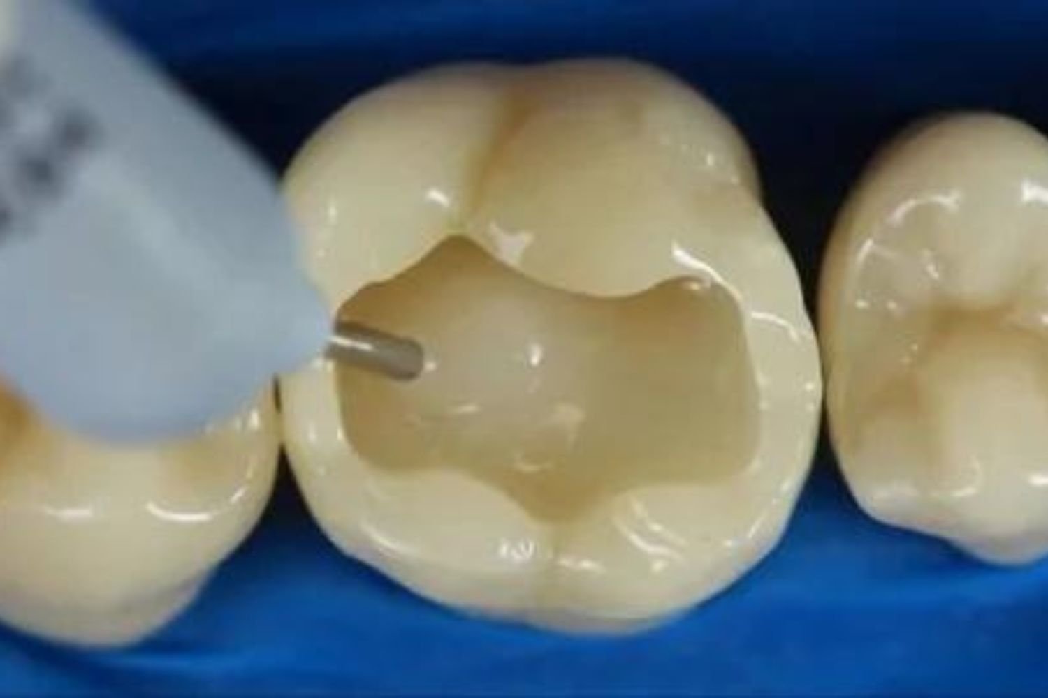Dental Services- Dental Composite Restoration
