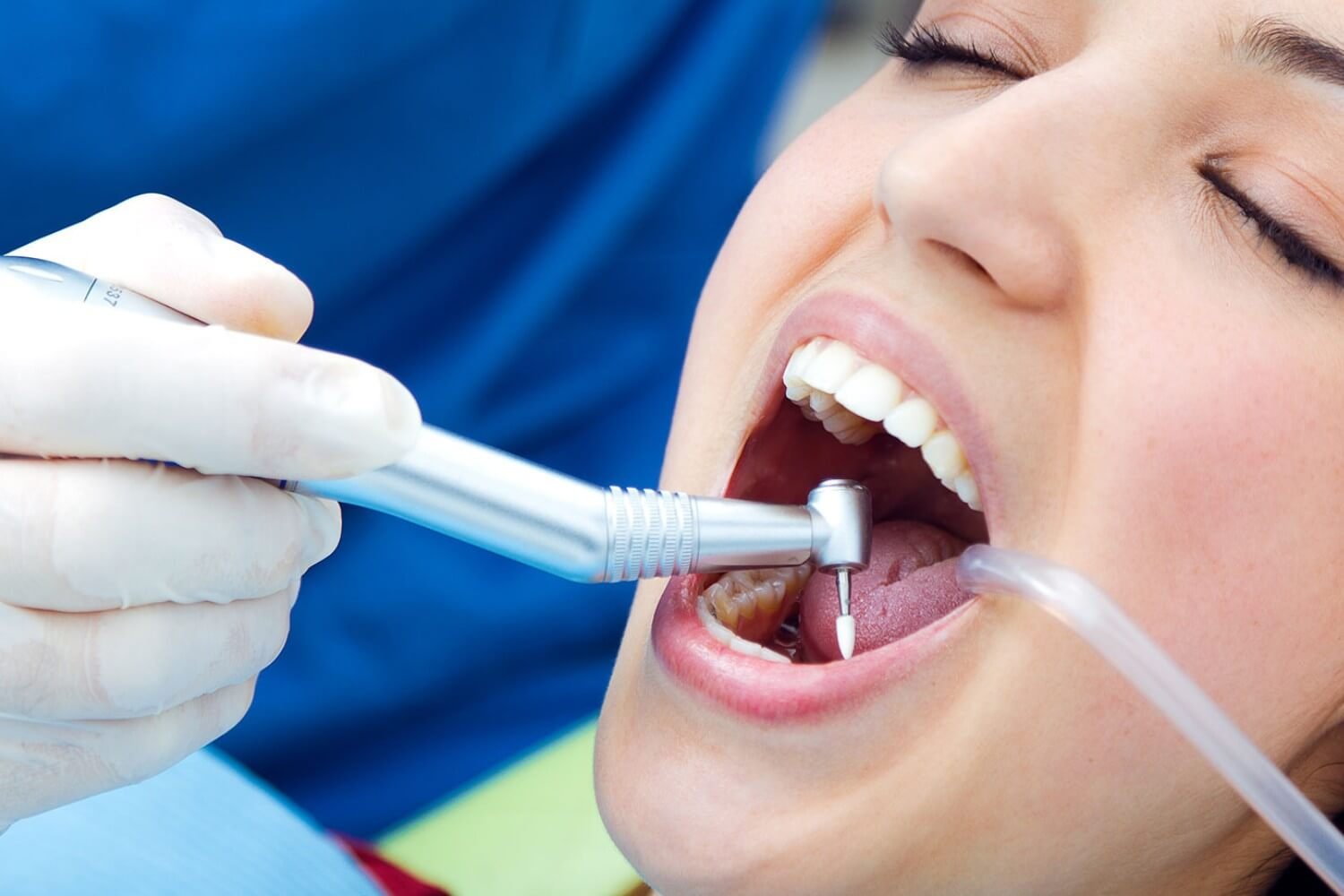 Dental Services- Dental Fillings