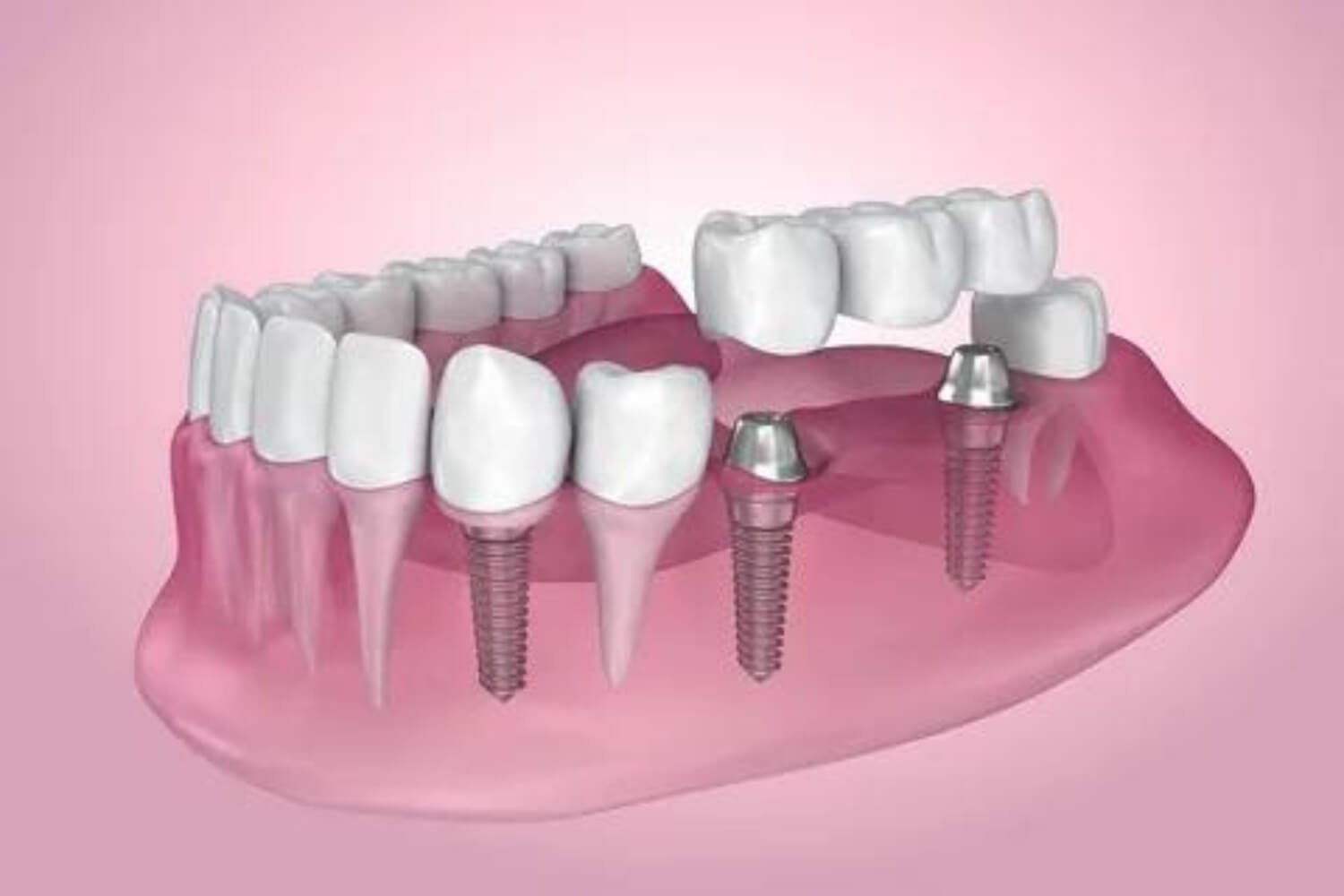 Global Dental Clinic and Implant Center