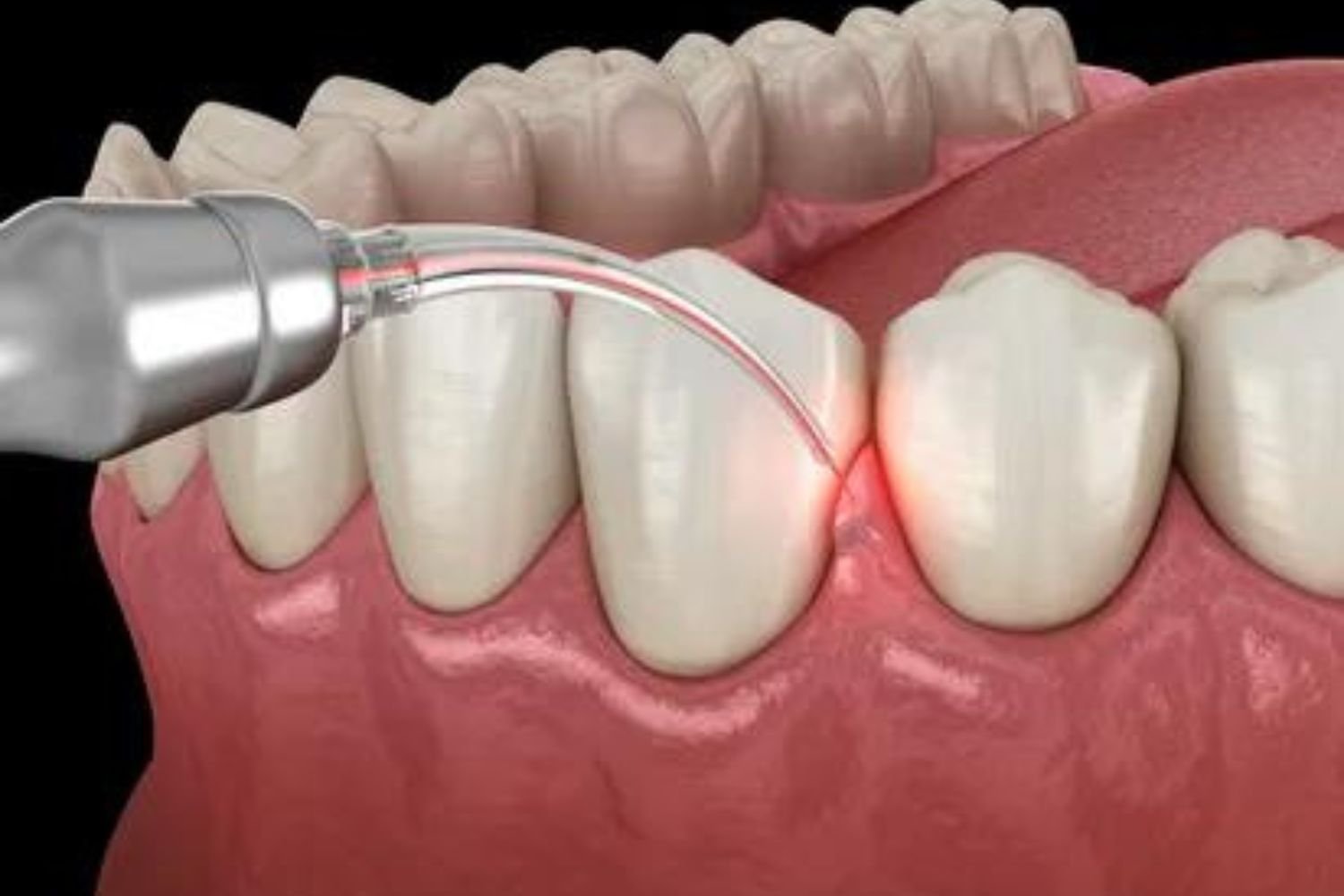 Dental Services- Gum Treatment