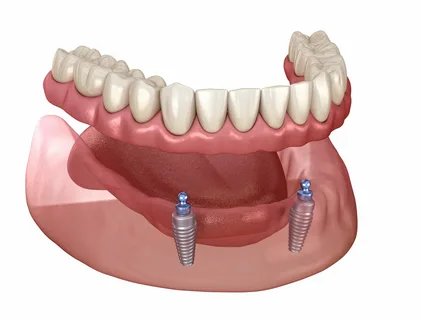 Dental Services- Implant Supported Dentures