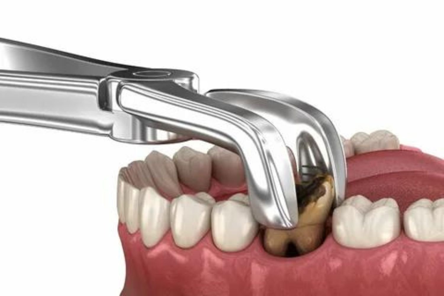 Dental Services- Tooth Extraction